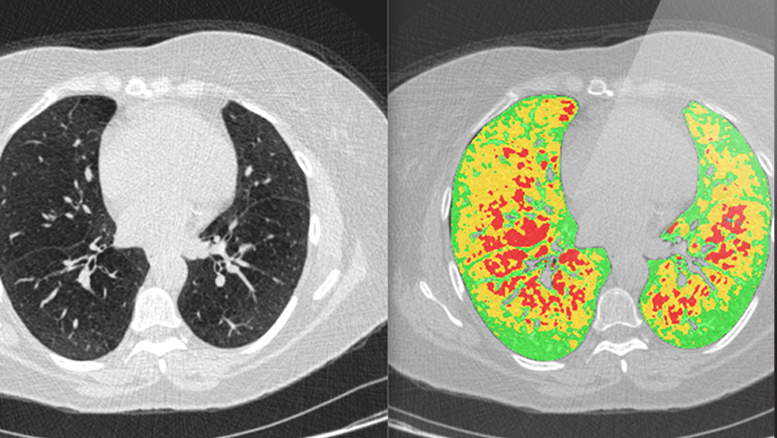 A screenshot of Imbio's Functional Lung Density Analysis