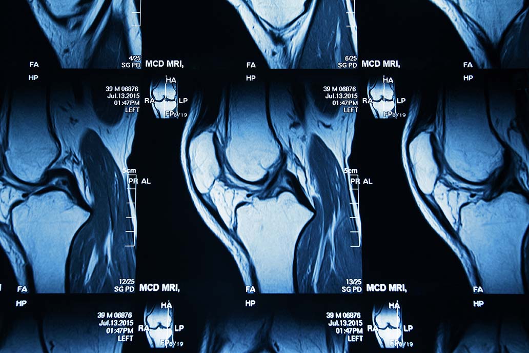 MRI image of knee joint leg closeup