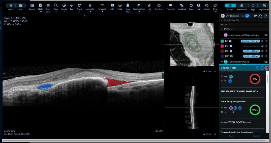 ophthalmology images on Flywheel medical imaging platform