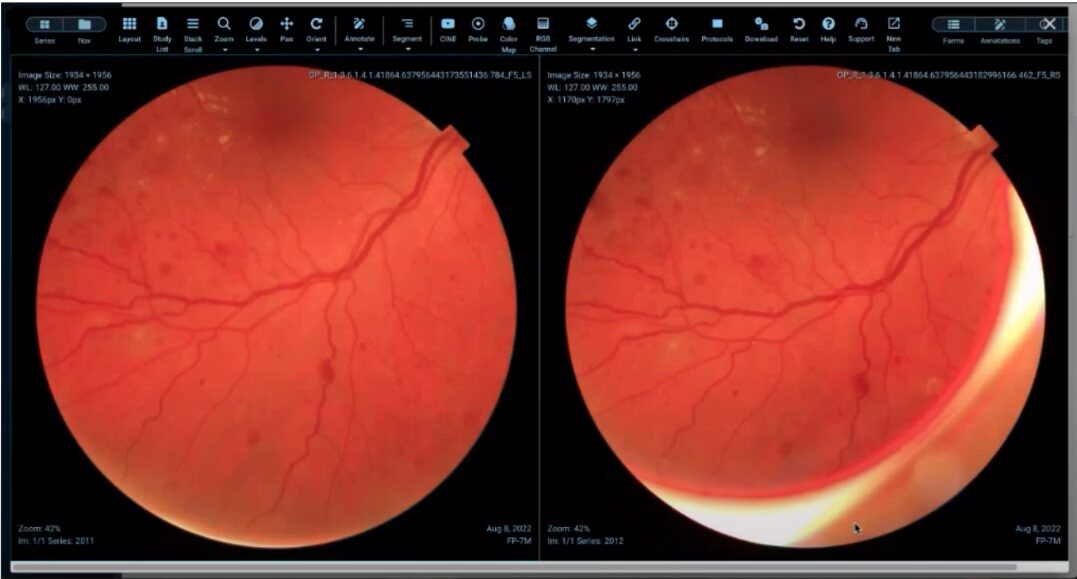 eye medical image on flywheel