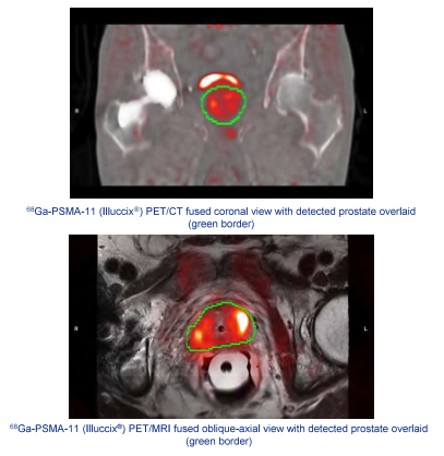 Enhancing Radiopharmaceutical Decision Support with Telixs AutoML and CDSS Platform